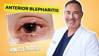 What Is Anterior Blepharitis? Causes, Symptoms & Treatments with Allen Austin, OD