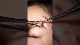Most Viral Pimple Pop Compilation &mdash; Pure Satisfaction&rdquo;