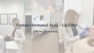 Adult Hormonal Acne | Lip Filler | Skin Checks