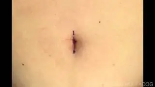 Making umbilical incision