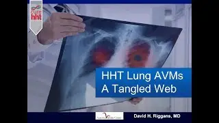 HHT Lung AVMs - A Tangled Web