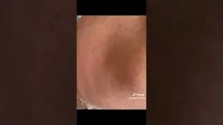 Extreme skinpeel after Sunburn