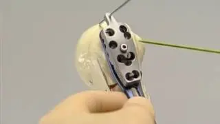 PHILOS The Proximal Humerus Internal Locking System by Adiy Ortho Point