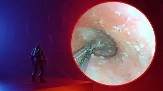 The Truth About earwax Will Shock You. How to remove earwax from ear, earwax extractions