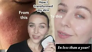 pm skin care routine that change my problematic-acne prone, rosacea skin, how I transformed my skin