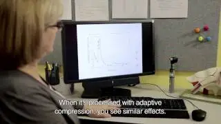 Advantages of Speech Guard E using Adaptive Compression in Oticon hearing aids