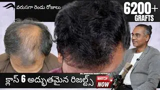 Hair Transplant In Hyderabad | Best Results Cost & Surgeon Of Hair Transplant Surgery In Hyderabad