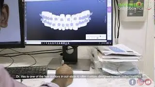 Invisible Orthodontics - Custom Braces