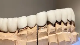 Dental Crown Benefits: A Versatile Restorative Option