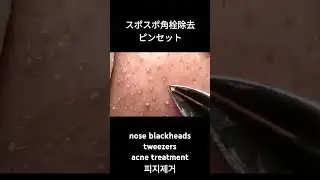 スポスポ角栓除去/relax/Satisfying/nose blackheads/tweezers/acne treatment/ピンセット/피지제거