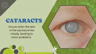 A cataract is a clouding of the eye's natural lens, which leads to blurry vision and difficulty s...