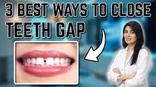 Midline Diastema Treatment Options | Best Ways To Close Teeth Gap | Female Dentist in Lahore