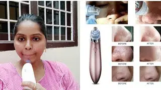 ఒక్క నిమిషంలో బ్లాక్ హెడ్స్|వైట్ హెడ్సని తేలికగా తొలగించవచ్చు |DermaSuction remover review and demo