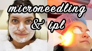 MY MICRONEEDLING AND IPL EXPERIENCE | BEFORE AND AFTER | ELA BOBAK