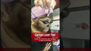 Carbon Laser Peel Treatment | Laser Toning for Skin | #Shorts | #ShortVideo | #YoutubeShorts