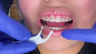 Flossing with Braces