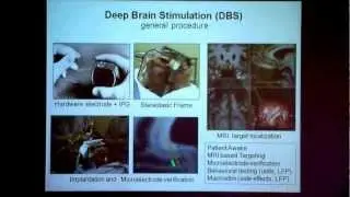 Helen Mayberg: Deep Brain Stimulation for Depression