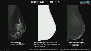 Contrast Enhanced Mammography - Course Sample