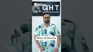 Fifteen Months Hair Transplant Results | Latest Fue Technique #shorts #viral #hair transplant