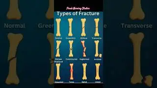 Types of fracture