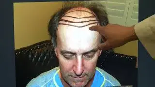 Hair Restoration Surgery on Straight Medium-Fine Hair by Dr. Diep. | MHTA Clinic