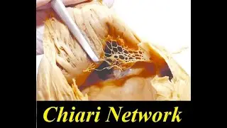 Chiari Network in right atrium of heart