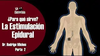 ¿Para qué sirve el estimulador epidural? | ¿Dónde se coloca? | Dr. Rodrigo Vilches | Parte 2