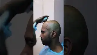 Mumbai Doctor Creates Perfect Hairline in One Session