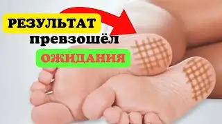 🔥🦶 Намазал йод на ноги перед сном &mdash; утром был В ШОКЕ!