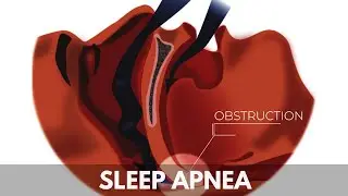 Sleep Apnea