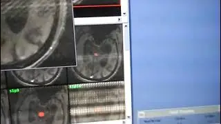 FLOW ANALYSIS #MRI BRAIN #GE  1.5T HDXT 