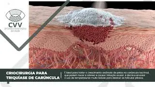 CRIOCIRURGIA PARA CORRE&Ccedil;&Atilde;O DE TRIQUIASE DE CAR&Uacute;NCULA