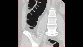 Virtual colonoscopy with normal fold pattern