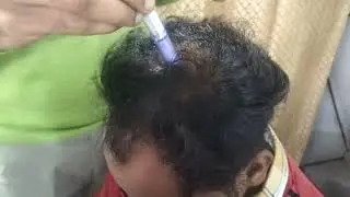 Hair PRP Treatment | Eye And Skin Hospital JBD Dr Rishi Thukral Leelawanti Hospital JBD
