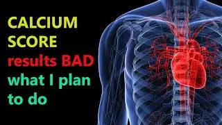 Calcium Score Heart Scan. My bad results plan.