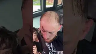 WORST HAIR RESTORATION EVER!!!! #dermreacts #hair #hairrestoration