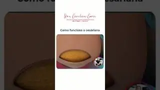 🤰 Como Funciona a Cesariana?