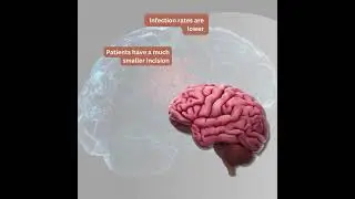 Keyhole Brain Surgery vs. Open Brain Surgery: Benefits You Need to Know