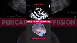 Pericardial Effusion (2D Echo vs 3D Animation) #shorts #hearthealth #animation #echocardiography