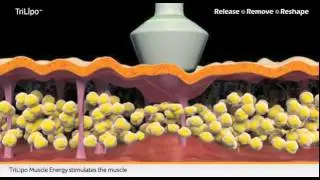 Trilipo for body contouring, facial sculpting, fat reduction, circumference reduction   YouTube 1