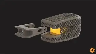 NanoHive Medical's Hive&trade; Soft Titanium&reg; lattice and DirectSync Surgical's Piezo Smart Sensor