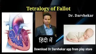Tetralogy of Fallot TOF in Hindi 