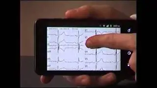 12 Lead Wireless ECG with Android