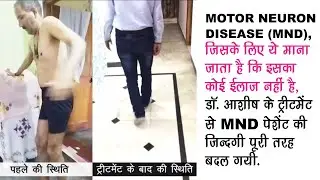 MND पेशेंट अच्छी तरह चलने लगा बिना परेशानी के और Muscles भी increase हो गयीं | Motor Neuron Disease