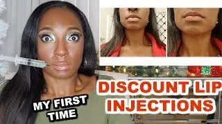I GOT DISCOUNT LIP INJECTIONS IN BEVERLY HILLS | LIP INJECTION PRICE + PROS & CONS | LIP FILLER VLOG