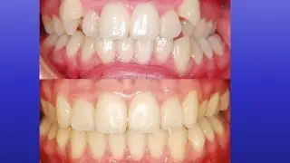 Amazing Orthodontics Treatment : Canines on Top
