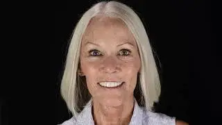 Carrie&rsquo;s Inspiring Smile Restoration: Zygomatic Implants by Dr. Winfield After Cancer Treatment