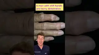 A man with bony deformities of the hands&hellip; what&rsquo;s the diagnosis? #shorts #medical #doctor #health