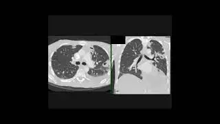 The best diagnosis in this patient who is short of breath is?