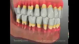 Dr. Wolfe, General Dentist in Rochester Hills, MI Shares a Video on Periodontal Disease